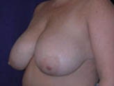 Patient # 68049 Before Photo # 3