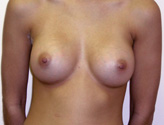 Patient # 42529 After Photo # 2