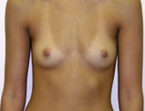 Patient # 42529 Before Photo # 1