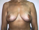 Patient # 36566 After Photo # 2