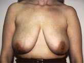 Patient # 36566 Before Photo # 1