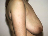 Patient # 36566 Before Photo # 3