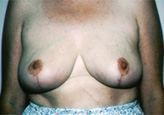 Patient # 22982 After Photo # 2
