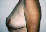 Patient # 22982 After Photo # 4