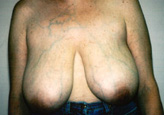 Patient # 22982 Before Photo # 1