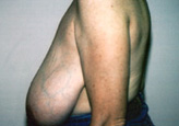 Patient # 22982 Before Photo # 3