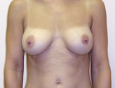 Patient # 45638 After Photo # 2