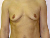 Patient # 45638 Before Photo # 1