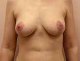 Patient # 96160 After Photo # 2