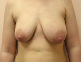 Patient # 96160 Before Photo # 1