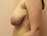 Patient # 96160 Before Photo # 3