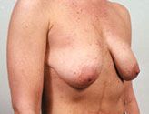 Patient # 55736 Before Photo # 1