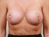 Patient # 69916 After Photo # 2