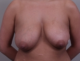 Patient # 34016 Before Photo # 1