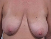 Patient # 35227 Before Photo # 1