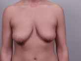 Patient # 53464 Before Photo # 1