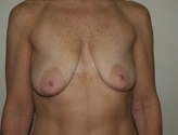 Patient # 22811 Before Photo # 1