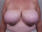 Patient # 61364 Before Photo # 1