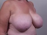 Patient # 61364 Before Photo # 3
