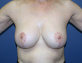 Patient # 15624 After Photo # 2