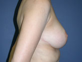 Patient # 15624 After Photo # 6