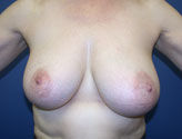 Patient # 15624 Before Photo # 1
