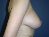 Patient # 15624 Before Photo # 5