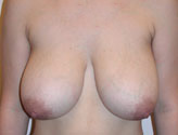 Patient # 15101 Before Photo # 1