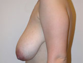 Patient # 15101 Before Photo # 3
