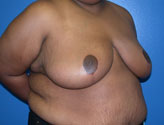 Patient # 58749 After Photo # 4