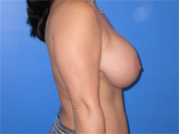 Patient # 50179 Before Photo # 5