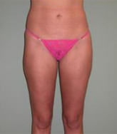 Patient # 84398 After Photo # 2