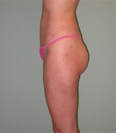 Patient # 84398 After Photo # 4