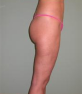 Patient # 84398 After Photo # 6