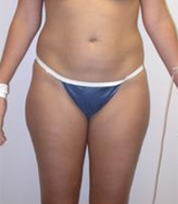 Patient # 84398 Before Photo # 1