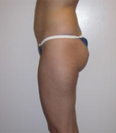 Patient # 84398 Before Photo # 3