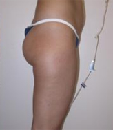 Patient # 84398 Before Photo # 5