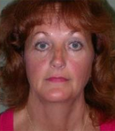 Patient # 12203 After Photo # 2