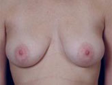 Patient # 74399 Before Photo # 1