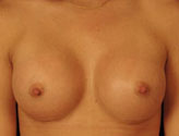 Patient # 82574 After Photo # 2