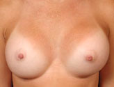Patient # 48598 After Photo # 2