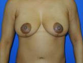 Patient # 88515 After Photo # 2
