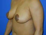 Patient # 88515 After Photo # 4