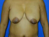 Patient # 88515 Before Photo # 1