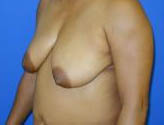 Patient # 88515 Before Photo # 3