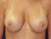 Patient # 88814 After Photo # 2