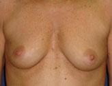 Patient # 88814 Before Photo # 1