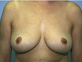 Patient # 79052 After Photo # 2