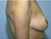 Patient # 79052 After Photo # 4