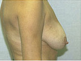 Patient # 79052 Before Photo # 3
